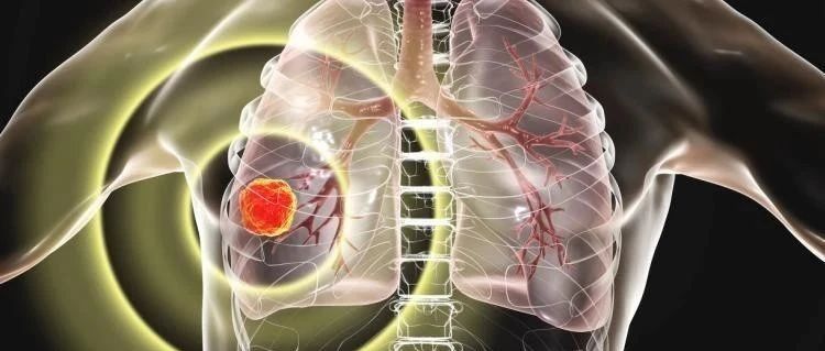 双层探测器光谱CT鉴别诊断肺癌与炎性结节的价值